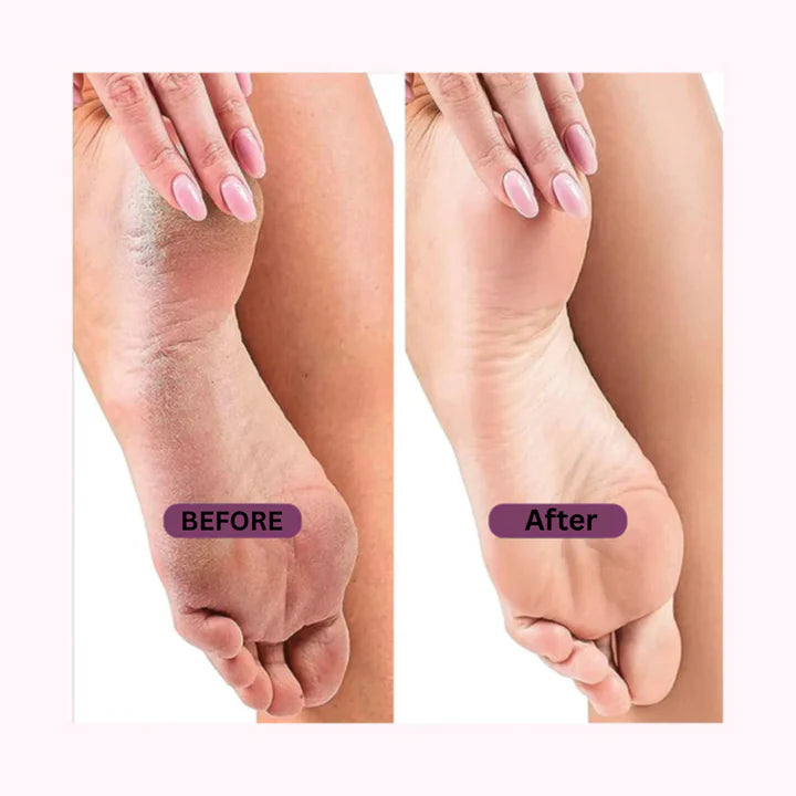 GloBare™ - Electric Callus Remover